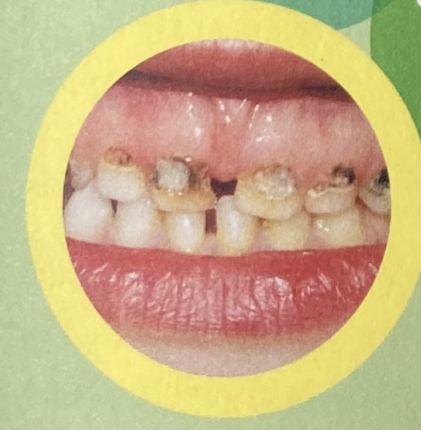 Dents abîmées par sucre